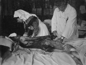 Sawyer Spence suffering extensive mustard gas blisters, Trent Bridge Hospital, Nottingham, 1918. © Jon Spence, used with permission.